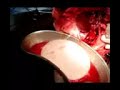 hydatid cyst brain