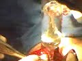 Cx luxaci�n de hombro 2a parte