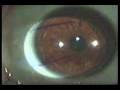 Cirurgia Corretora de Miopia