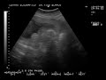 Bebe 20 semanas de frente