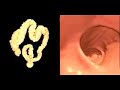 Gastrologo Sigmoidoscopy