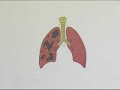 A Surgeon Explains How Smoking Damages the Lungs