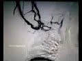 blood clot