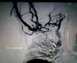 blood clot