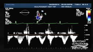 Calculating Aortic Valve Area with the Continuity Equation