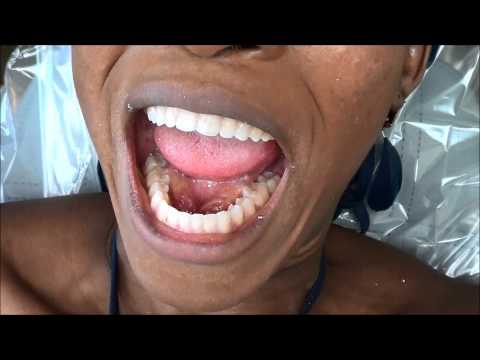 how to dissolve orthodontic cement