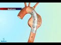 Stent Graft Procedure for a Penetrating Aortic Ulcer in an 80 yof performed by V. Seenu Reddy MD, MBA, FACS, Assistant Professor of Surgery at UT Health Science Center San Antonio at Christus Santa Rosa Hospital and reported on WOAI TV San Antonio.
