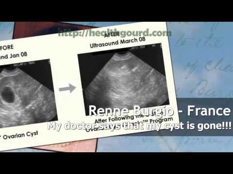 how to dissolve pco naturally