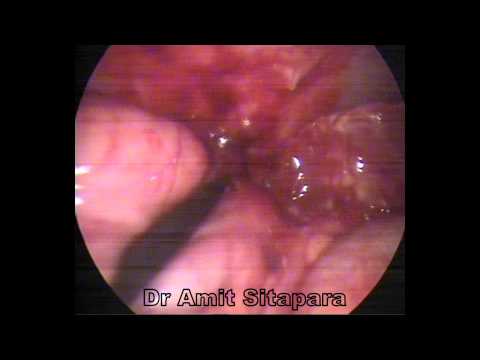 how to drain appendix abscess