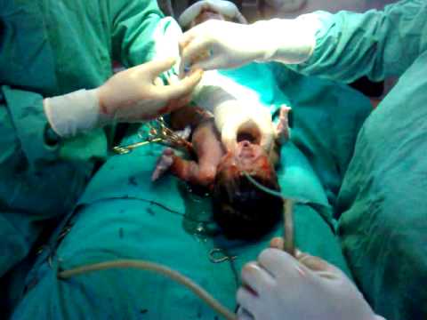 Delivery+of+baby+video+in+india