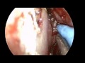 Transnasal Transsphenoideal Approach to the Pituitary Transnasal Transsphenoideal Approach to the Pituitary