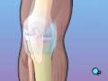 Malpractice Medical Anterior Cruciate Ligament Arthroscopic Repair Surgery 1