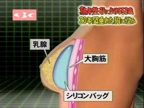 豊胸術Youtube(ユーチューブ・ゆーちゅーぶ)・Dailymotion動画