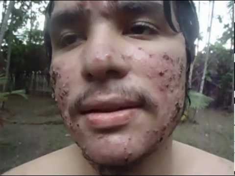 Acne grave rosáceas grau elevado -1º mês do Roacutan
