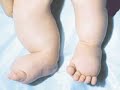 Lymphatic malformations