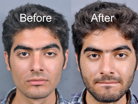 how to repair ptosis