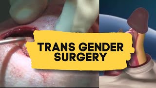 Trans gender surgery  Male to Female  Education