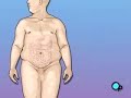 PreOp® Patient Education: Gastric Bypass Open Surgery PreOp® Patient Education: Gastric Bypass Open Surgery