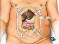 PreOp-Patient-Educat