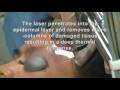 ProFractional Laser Acne Scar Removal ProFractional Laser Acne Scar Removal