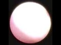 sialendoscopy of parotid lithiasis