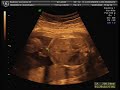 Bernardita Belen 25 semanas