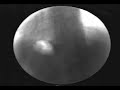 right lung is clean and healthy - compare with left lungle poumon droit est propre et sain - comparez avec le poumon gauche