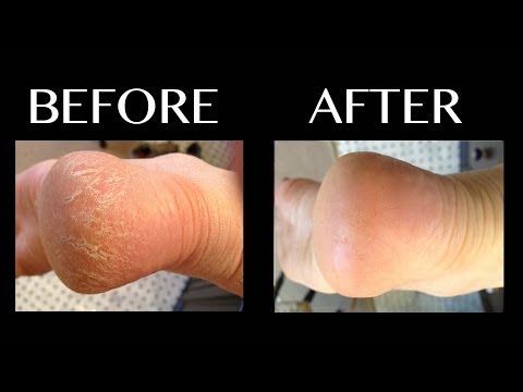how to fix cracked heels