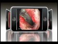 Animación de Endoscopia con Cancer Gastrico