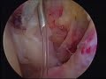 Frozen shoulder intraarticular catherization ?????????? Frozen shoulder intraarticular catherization ??????????