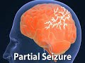 Types of Seizures (Epilepsy #2)