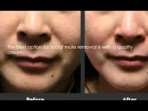 how to remove a mole