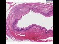 Histopathology Esophagus--Zenkers diverticulum
