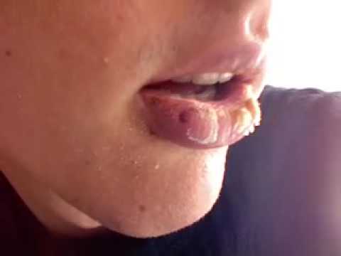how to cure exfoliative cheilitis