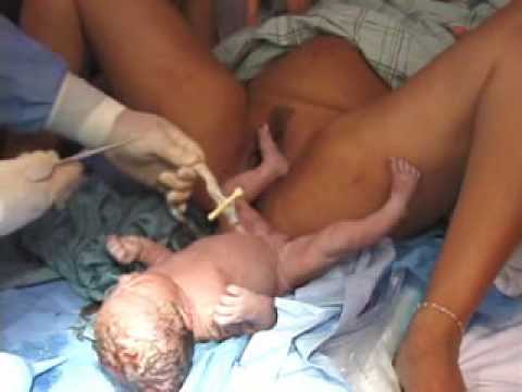 how to remove umbilical cord clamp