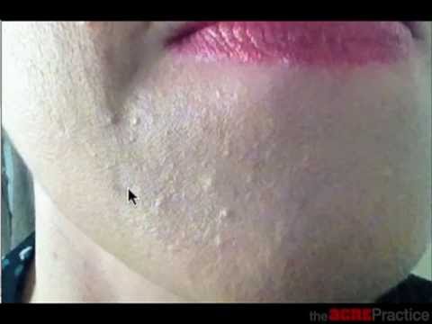 how to cure small pimples on forehead