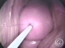 ART 3: IVF & Embryo Transfer (Infertility Treatment) ART 3: IVF & Embryo Transfer (Infertility Treatment)