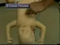Infant Airway Obstruction