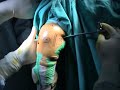 elbow arthroscopy anteromedial portal ผ่าตัดส่องกล้อง elbow arthroscopy anteromedial portal ผ่าตัดส่องกล้อง