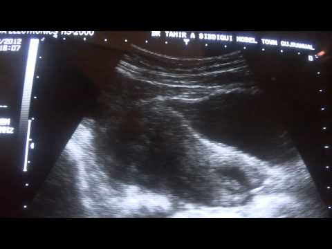 how to locate ovaries on ultrasound