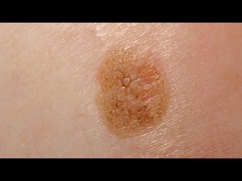 how to get rid brown spots on face