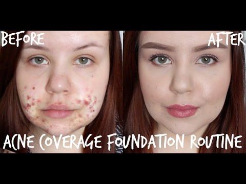 Acne Coverage Foundation Routine ♡ Full Coverage for Cystic Acne/Scarring
