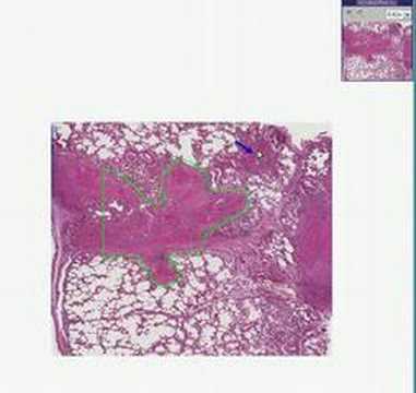 Histopathology Lung --Silicosis