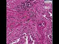 Histopathology Lung --Silicosis Histopathology Lung --Silicosis