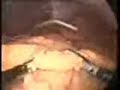 Cirug�a laparosc�pica de triple obesidad