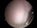 Torn Labrum