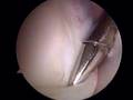 Torn Labrum