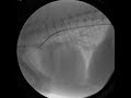 Patent Ductus Arteriosus Angiogram PreCoil Patent Ductus Arteriosus Angiogram PreCoil