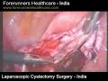 Removal of urinary bladder with cystectomy in India. Small Intestine Cancer