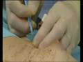 Macrolane Breast Filler:
